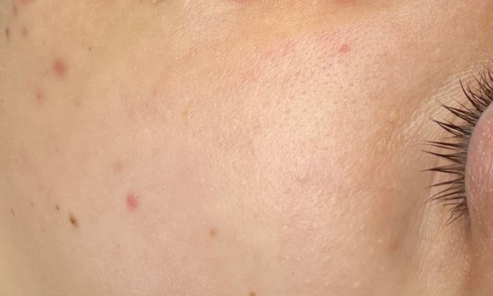 Unreine Haut an der Wange mit Pickeln und Rötungen vor kosmetischer Behandlung