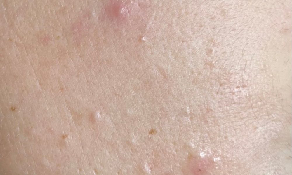 Haut mit entzündlicher Akne und verstopften Poren vor Gesichtsbehandlung